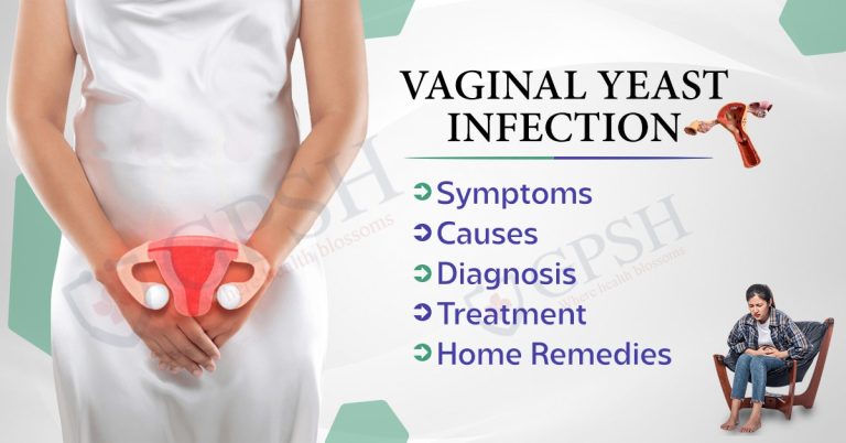 Vaginal Yeast Infection Symptoms Causes Diagnosis Treatment And Home Remedies 