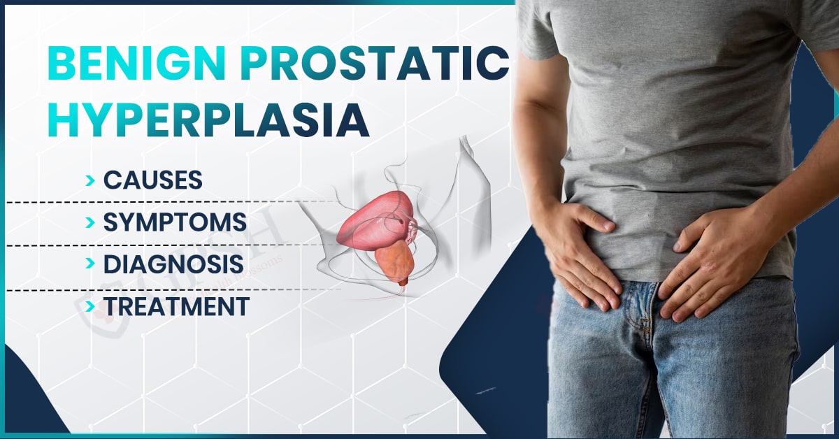 Benign Prostatic Hyperplasia – Causes, Symptoms, Diagnosis and Treatment